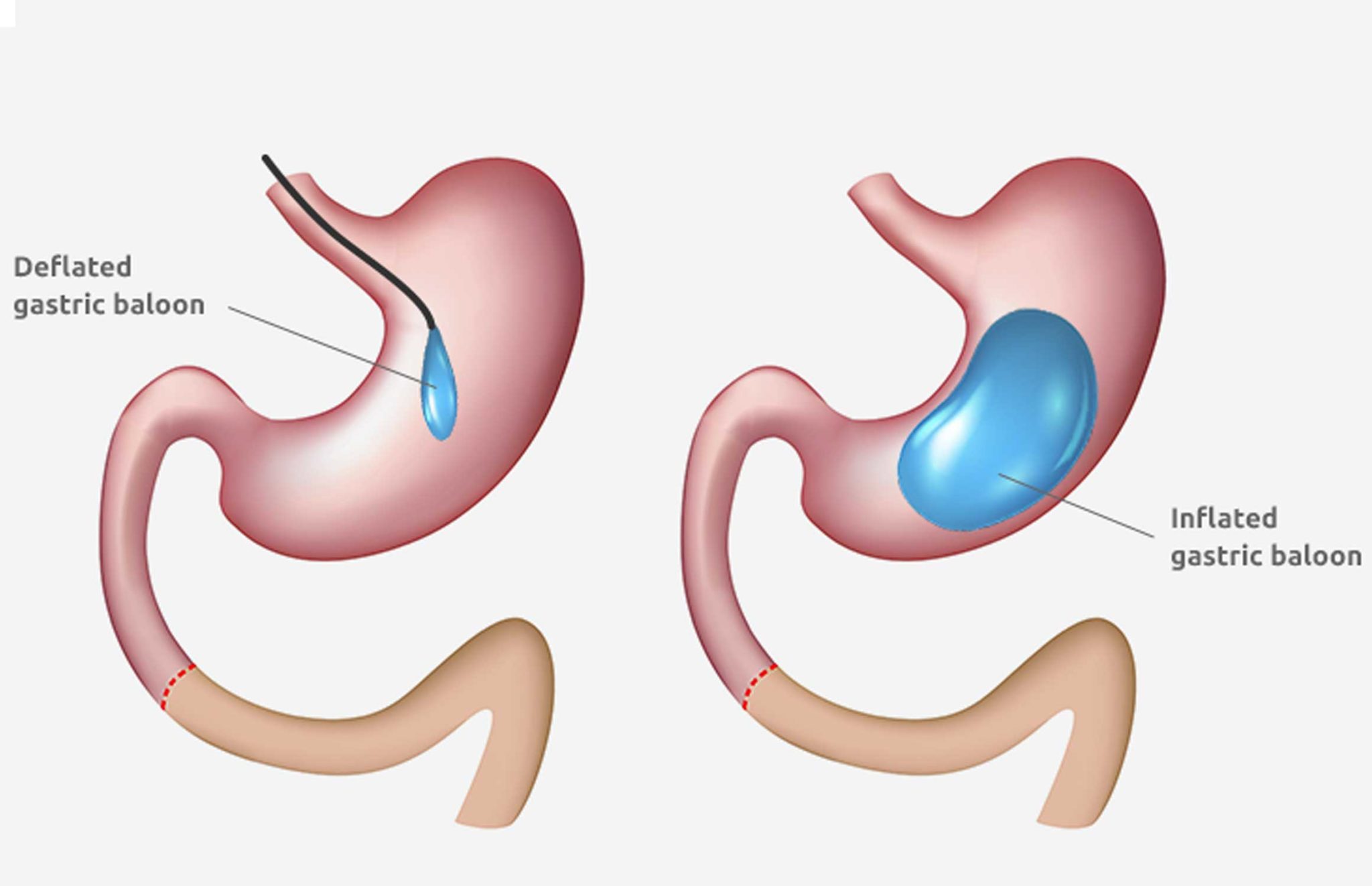 Бариатрия желудка. Gastric Balloon Dubai.